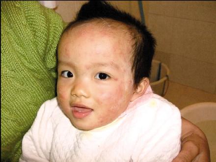 強(qiáng)生潤膚霜致幼兒過敏僅賠600稱產(chǎn)品合格(圖)