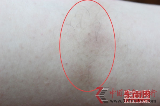 林小姐使用云南白藥氣霧劑后,長出1厘米黑毛 林小姐使用云南白藥氣霧劑后,長出1厘米黑毛